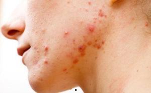 国产修复痘痘视频,揭秘国产修复痘痘视频的神奇效果